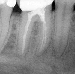 Röntgenbild Zahnwurzel